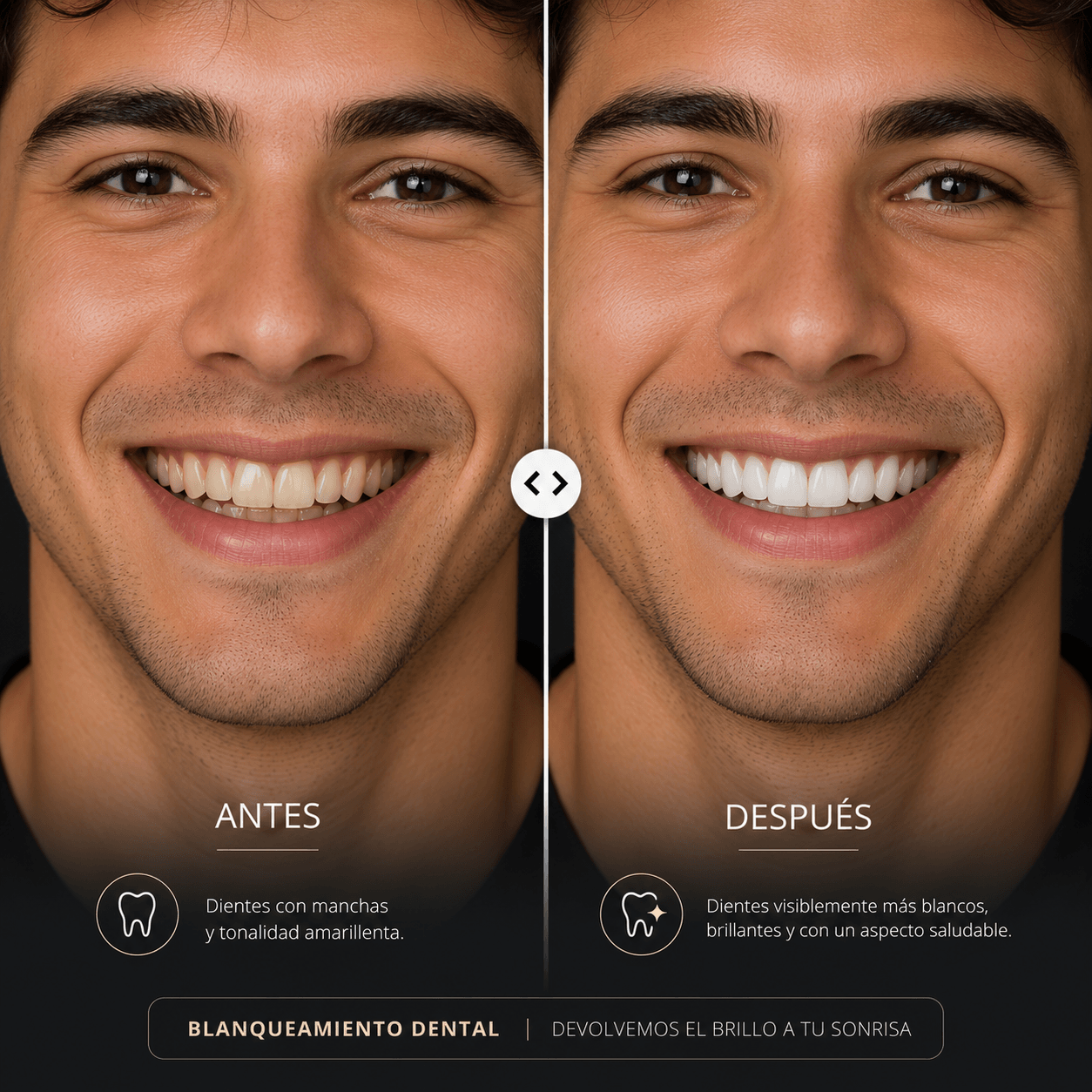 Caso blanqueamiento dental